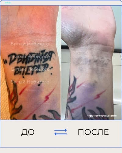 Удаление татуировки